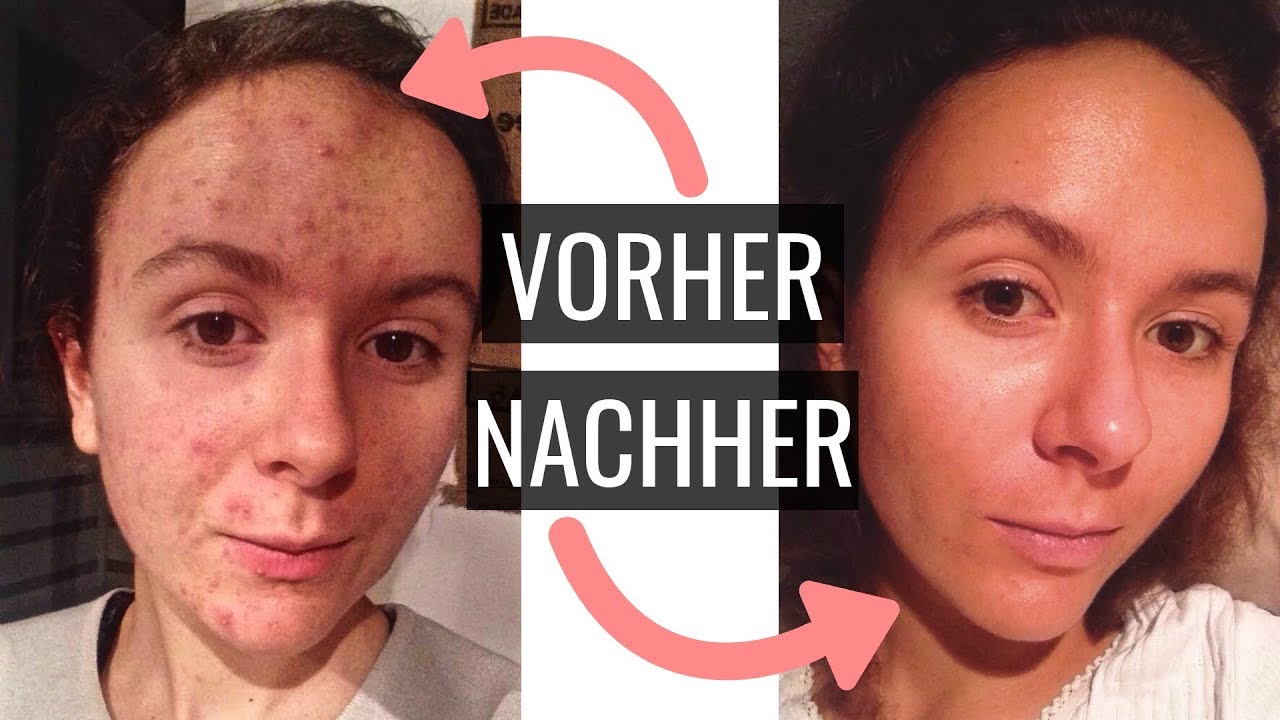 MEINE HAUT » Erfahrungen und Tipps gegen Akne und Pickel