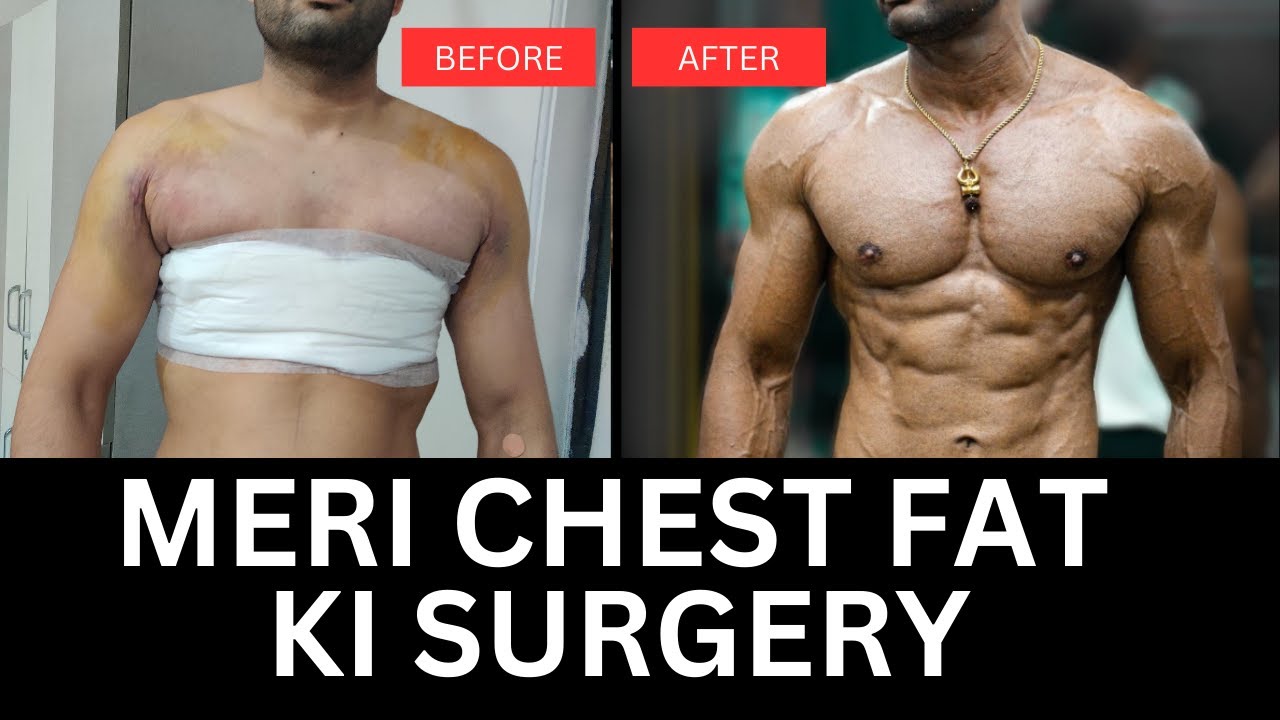 Meri male boobs ki surgery - Operation karwaya - kitne paise lage - Tarun Gill Talks