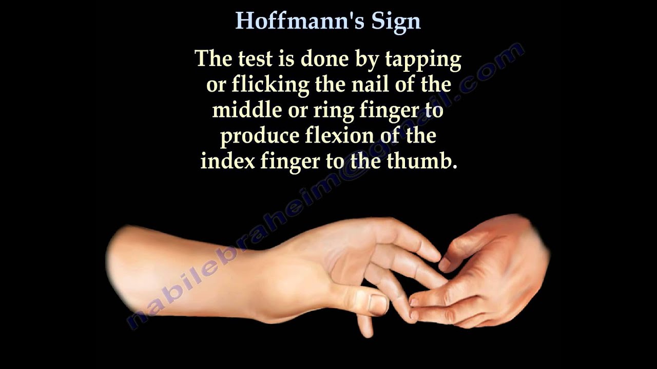Hoffmann's Sign - Everything You Need To Know - Dr. Nabil Ebraheim