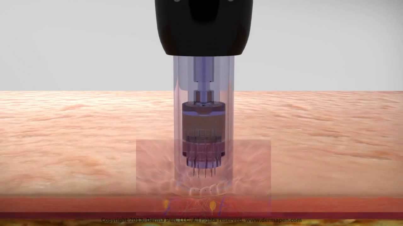 Dermapen e Micro agulhamento para cicatriz estrias e rejuvenescimento- Dermatologia Sao Paulo