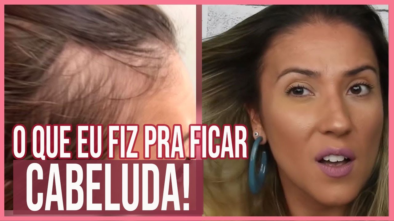 Como melhorei da CALVICIE E QUEDA CABELO e consegui mais VOLUME. Sem usar remédio! #papodecabelo