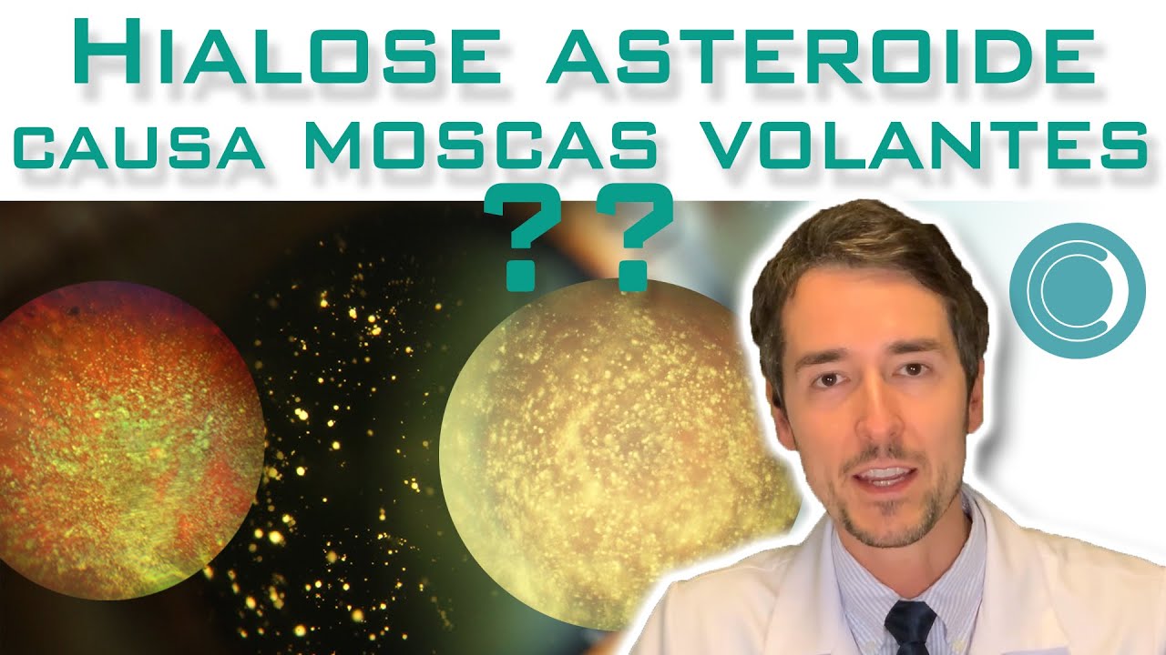 Hialose asteroide causa moscas volantes ?