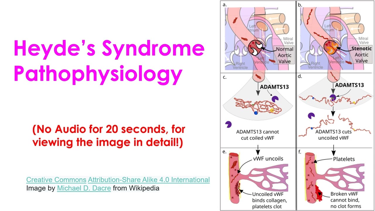Heyde&rsquo;s Syndrome in Severe Aortic Stenosis
