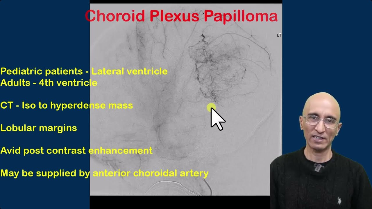 Choroid Plexsus Papilloma
