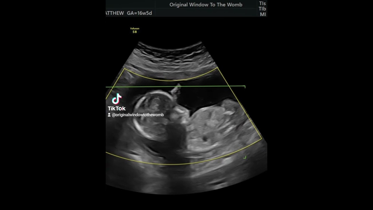 16 weeks baby gender scan! #ultrasoundpics #babygirl ##babyboy #baby #4DScan #heartbeat #Nottingham