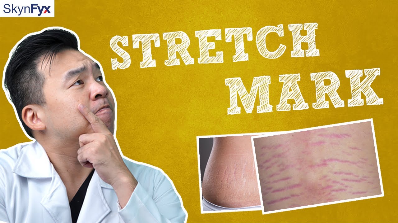 Cure For Stretch Marks?