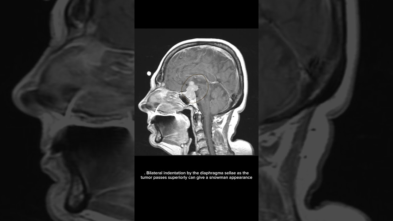 A Bit For a Day - 101|| Pituitary macroadenomas||#neetpg #fmge #medicalstudents #doctor#medico