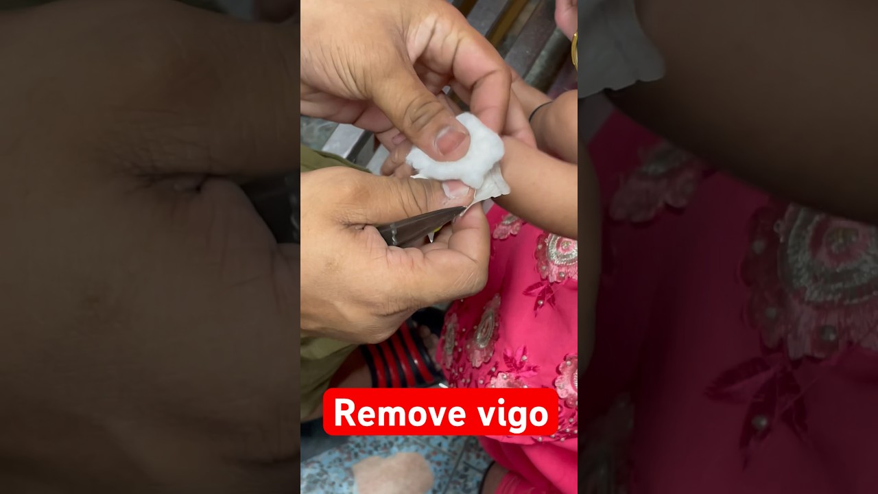 Remove vigo in baby 👶 | #vigo #cannula #cannulation #shorts #trending @Sayed_muaz plz subscribe