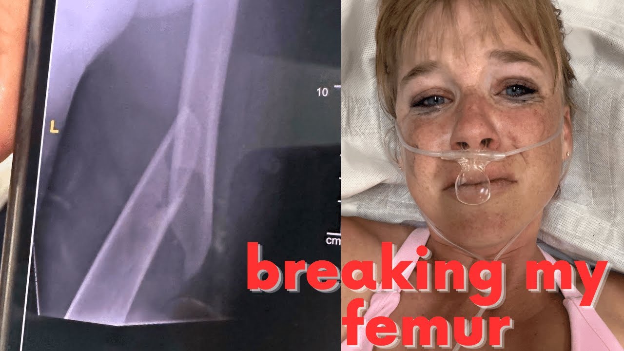 I broke my FEMUR- now what?