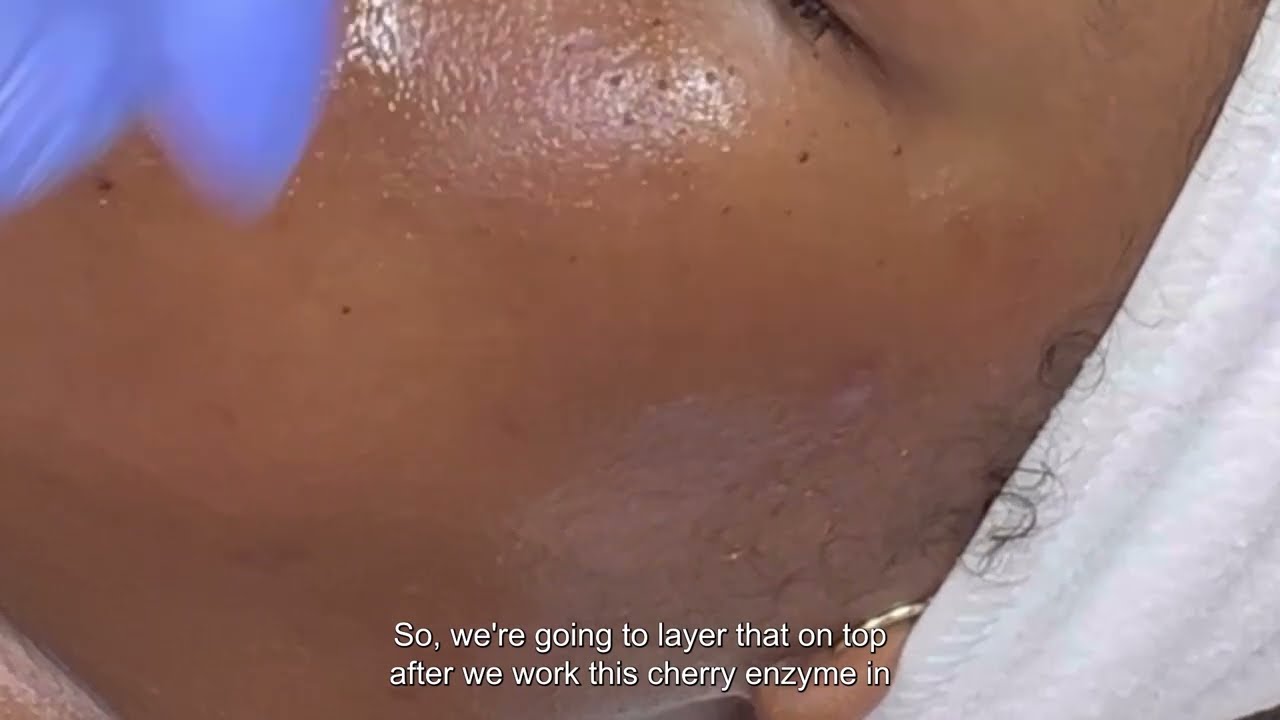 Signature Glow Facial|Custom Facial for Dark Spots & Breakouts| Dermaplaning & Hydrodermabrasion