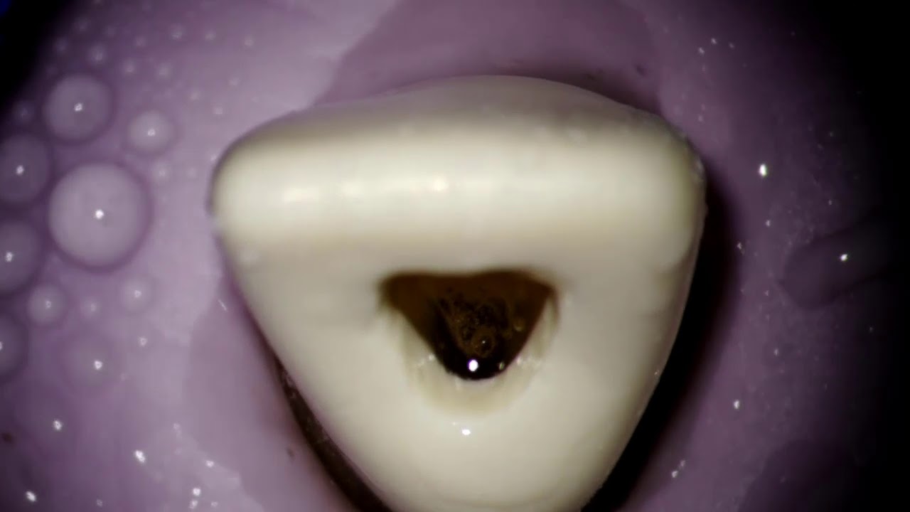 IOD - Endodontics - Access cavity