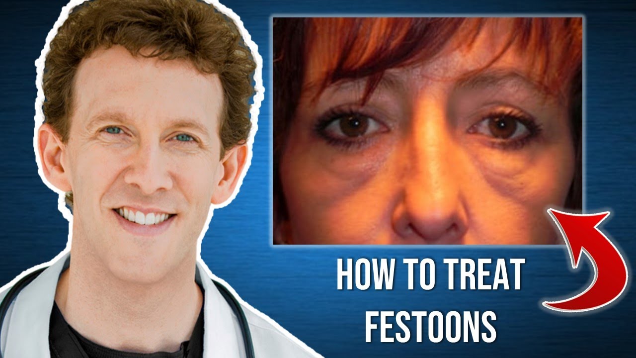 How to Treat Malar Mounds and Eyelid Festoons?