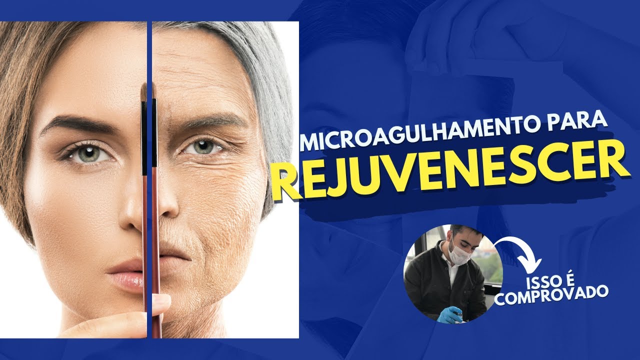 MICROAGULHAMENTO NO REJUVENESCIMENTO - PERGUNTAS E RESPOSTAS