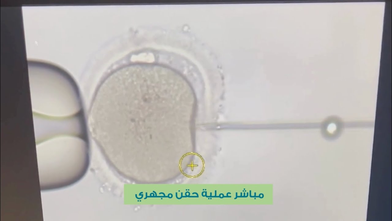 عملية الحقن المجهري مع شرح مفصل للخطوات مباشرة من مركز عازوري لأطفال الأنابيب.