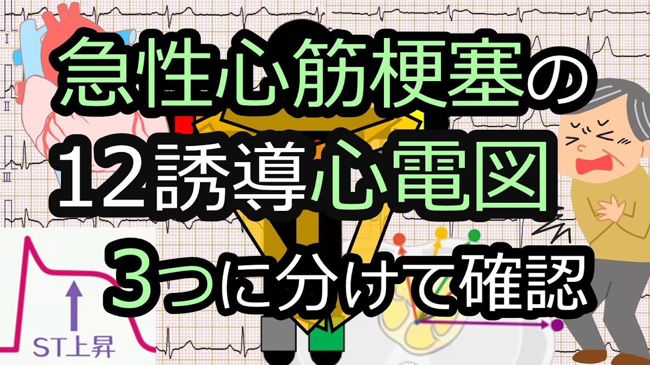 ST上昇の急性心筋梗塞の12誘導心電図は３つ(+1)に分けて考えよう