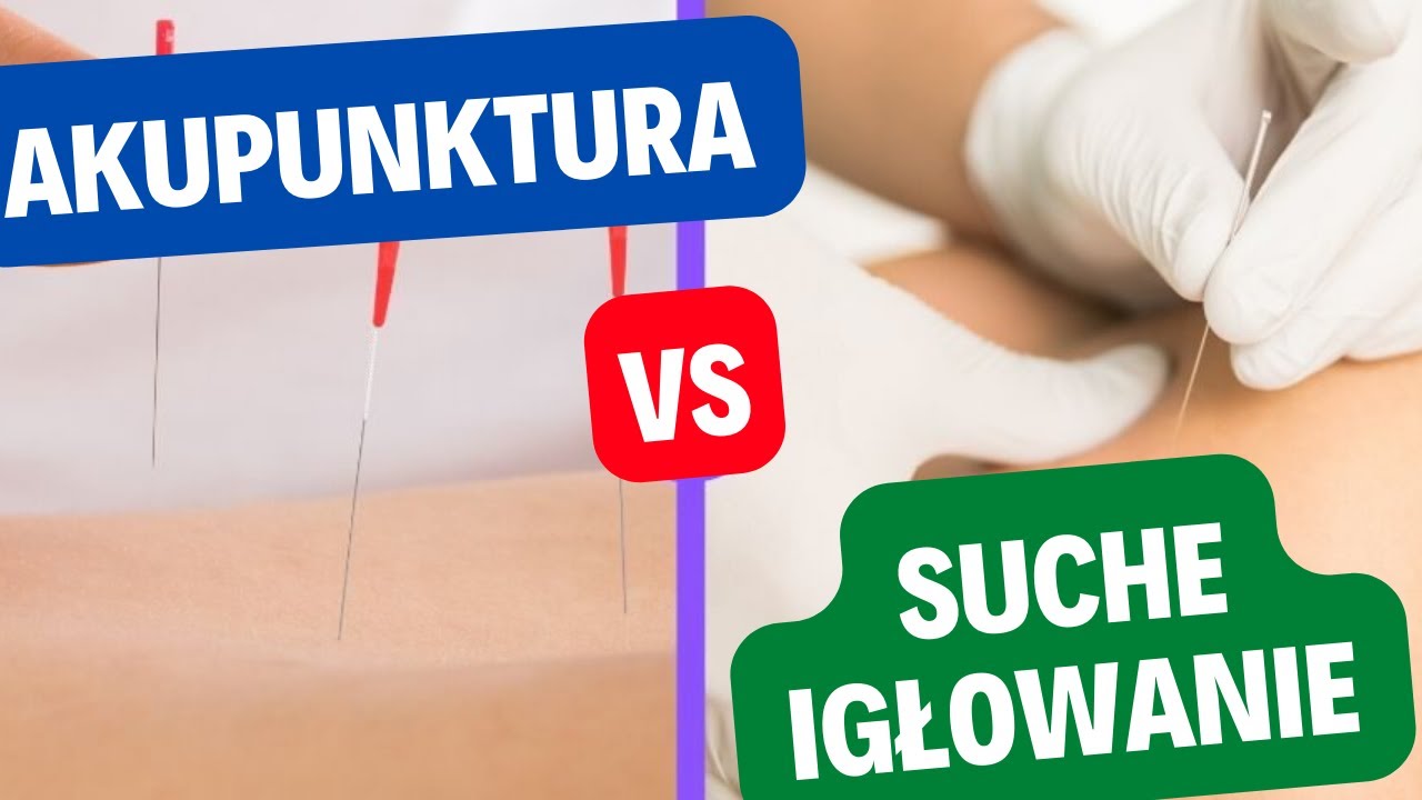 Akupunktura vs Suche Igłowanie (dry needling)