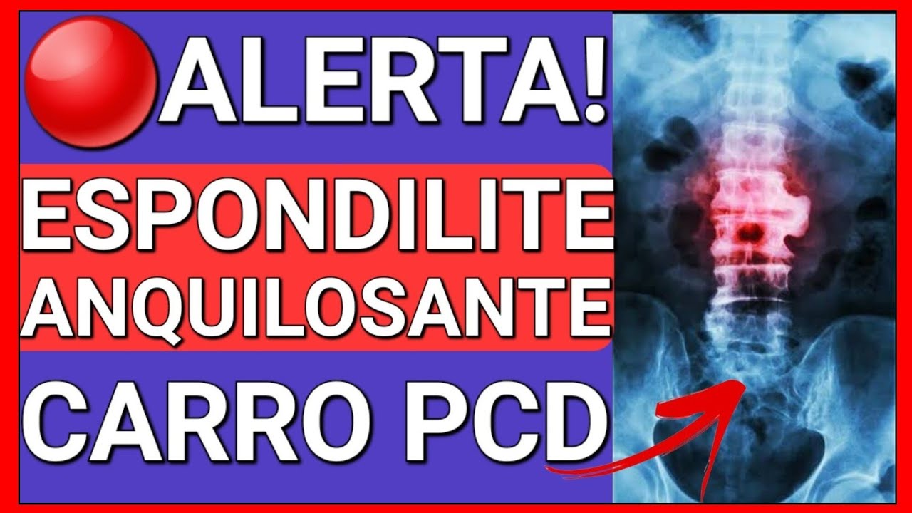 COMO A ESPONDILITE ANQUILOSANTE DÁ DIREITO AO CARRO PCD