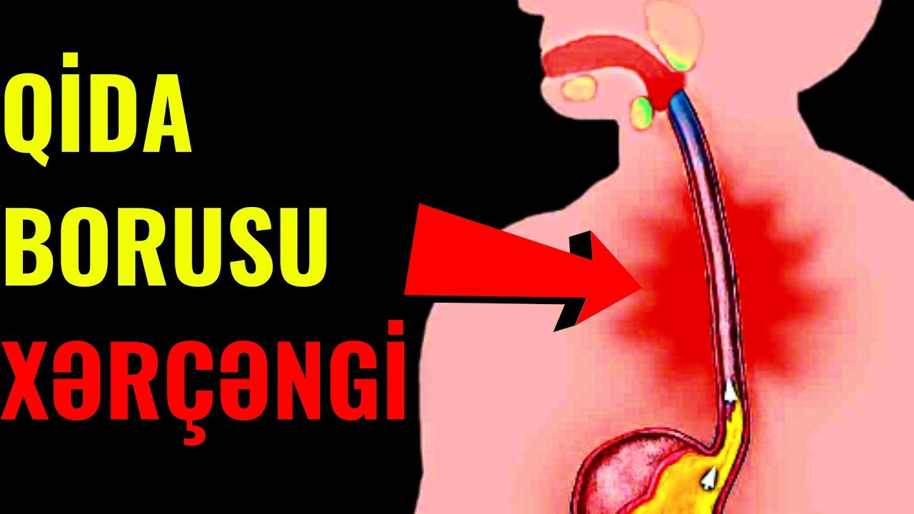 Kürəkdə Ağrı , Qusma Bu Əlamətlər Varsa Qida Borusu Xərçənginə DİQQƏT!