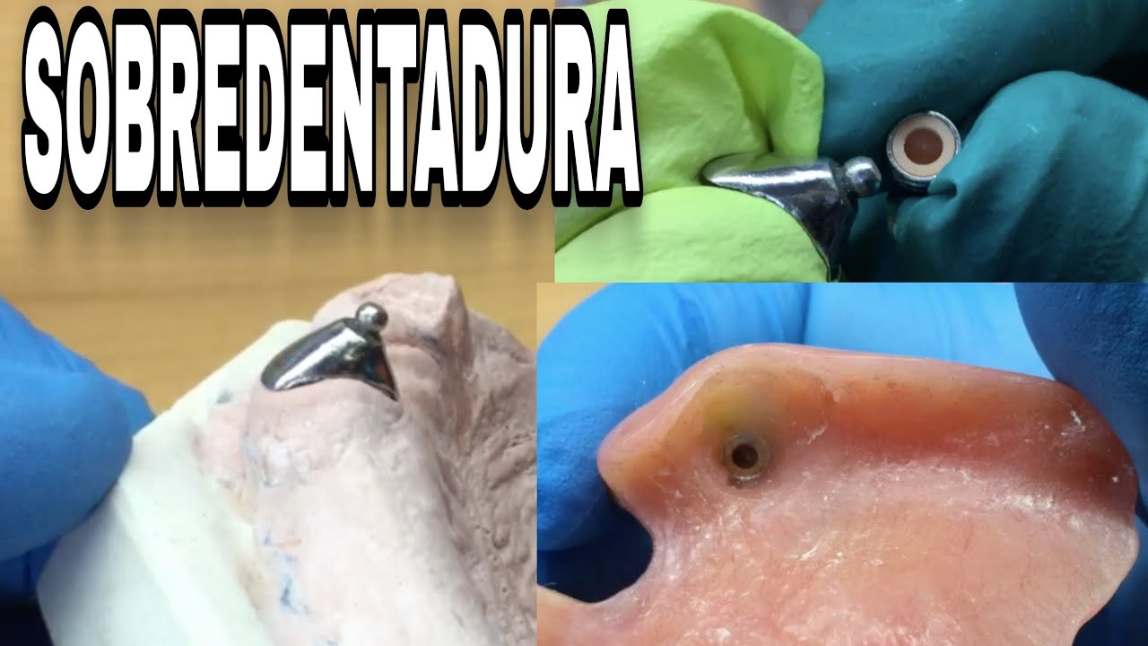 CÓMO COLOCAR ADITAMENTO A PRÓTESIS DENTAL? Sobredentadura