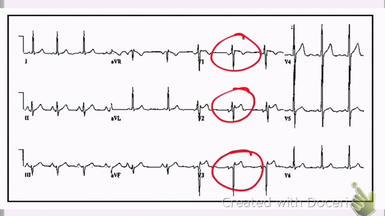 ECG In syncope