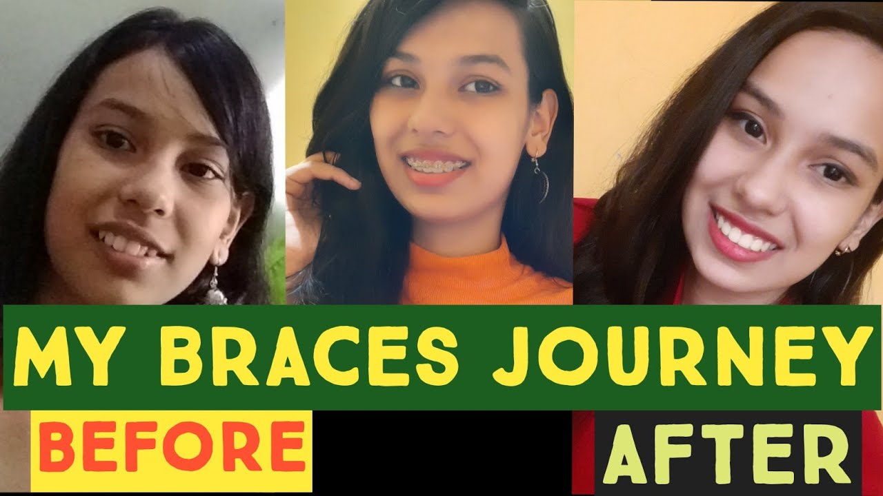 braces time lapse/My braces journey/q n a related to braces/all about braces/braces transformation