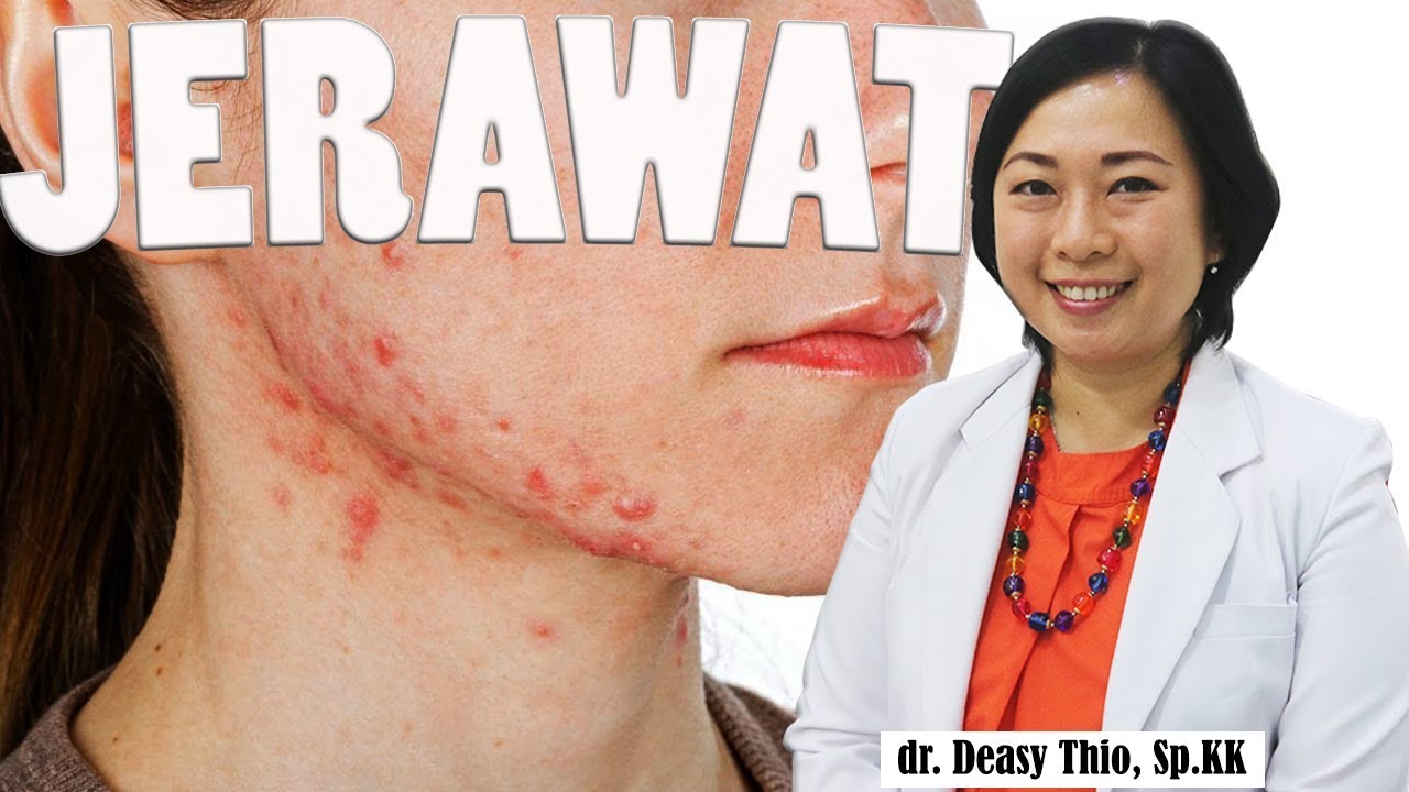 Jerawat - Penyebab - Cara Menghillangkan & Pencegahan : dr. Deasy Thio, Sp.KK