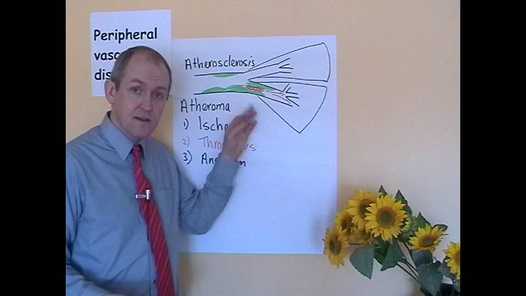Peripheral vascular disease, Part 1, Arterial disease