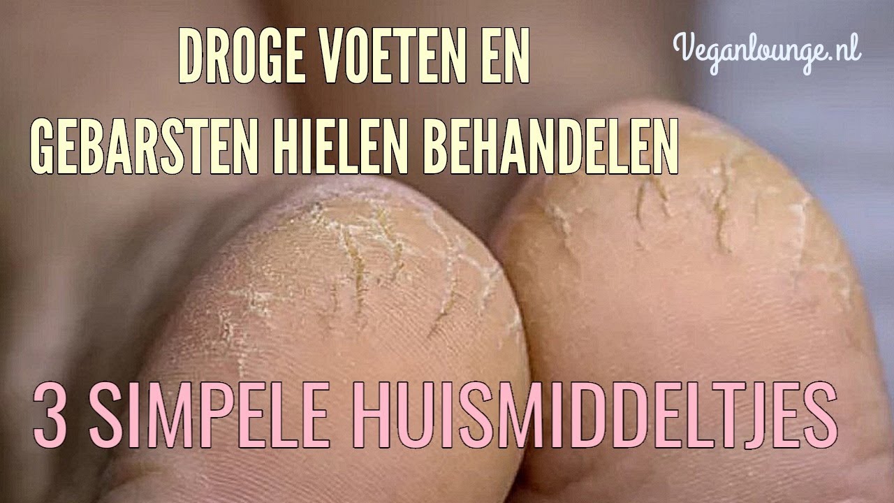 DROGE VOETEN EN GEBARSTEN HIELEN NATUURLIJK BEHANDELEN MET DEZE 3 SIMPELE HUISMIDDELTJES.💮🌸🌺