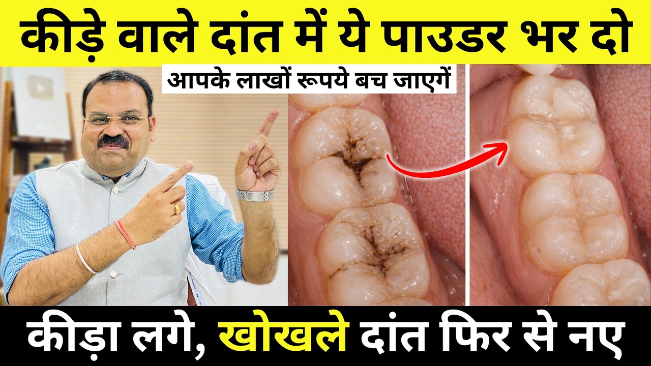 5 मिनट में दांत का दर्द और कीड़े खत्म करने का घरेलू इलाज - Remedy For Tooth Cavity | Dr Bhushan