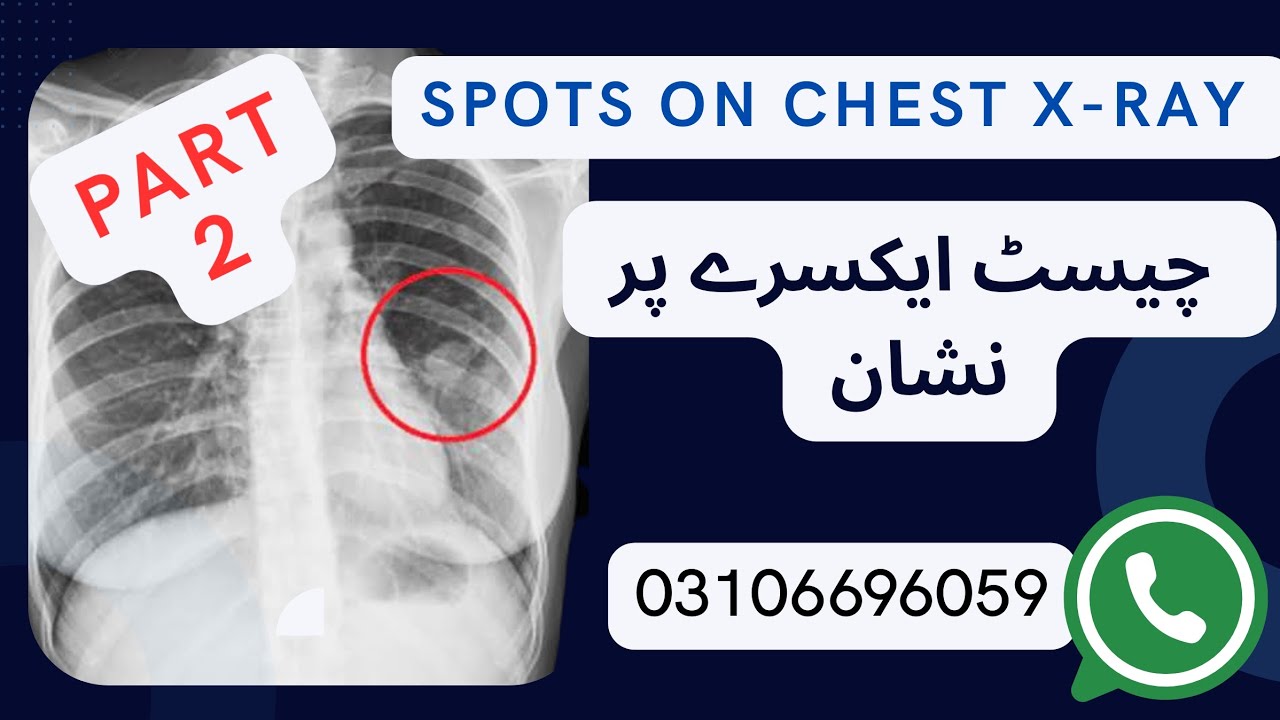 Spots on Chest Xray (Part 2) چیسٹ ایکسرے پر نشان #GAMCA #MEDICAL #VISA #TRAVEL #Fitness 