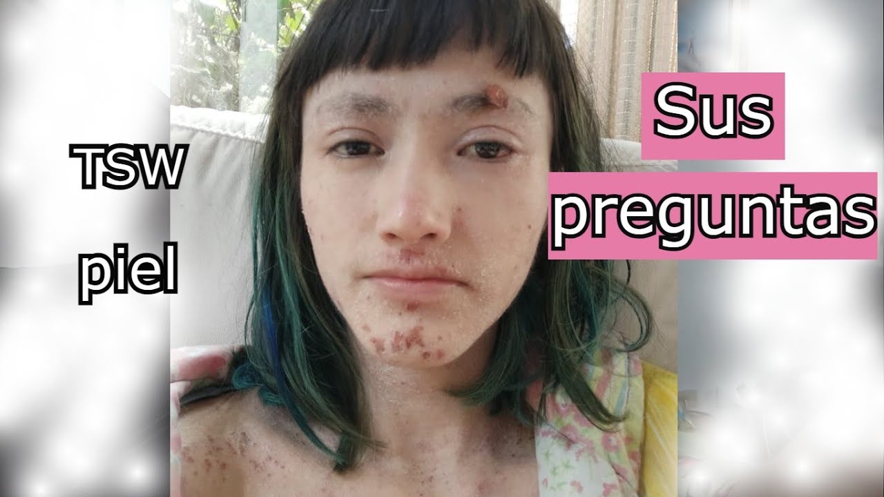Respondo sus preguntas sobre TSW, piel, sanación