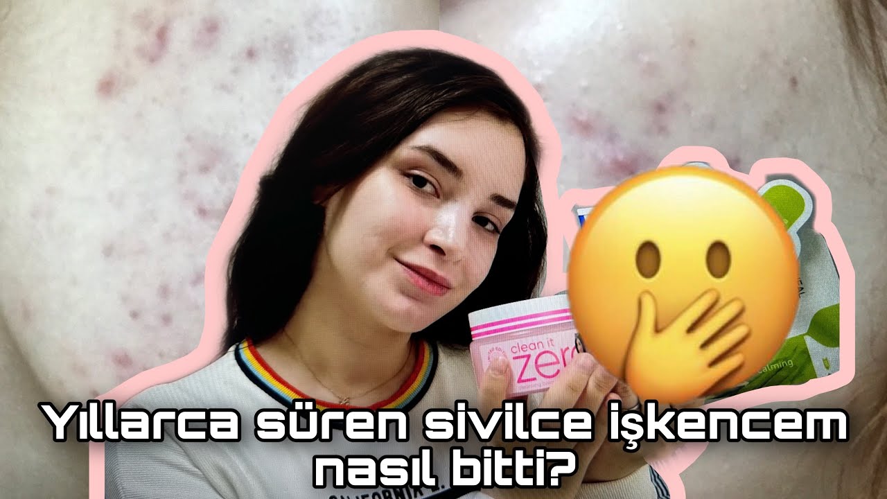 SİVİLCELERİMDEN NASIL KURTULDUM? |Gerçekçi akne serüvenim😩 #ilaçtedavisiolmadan