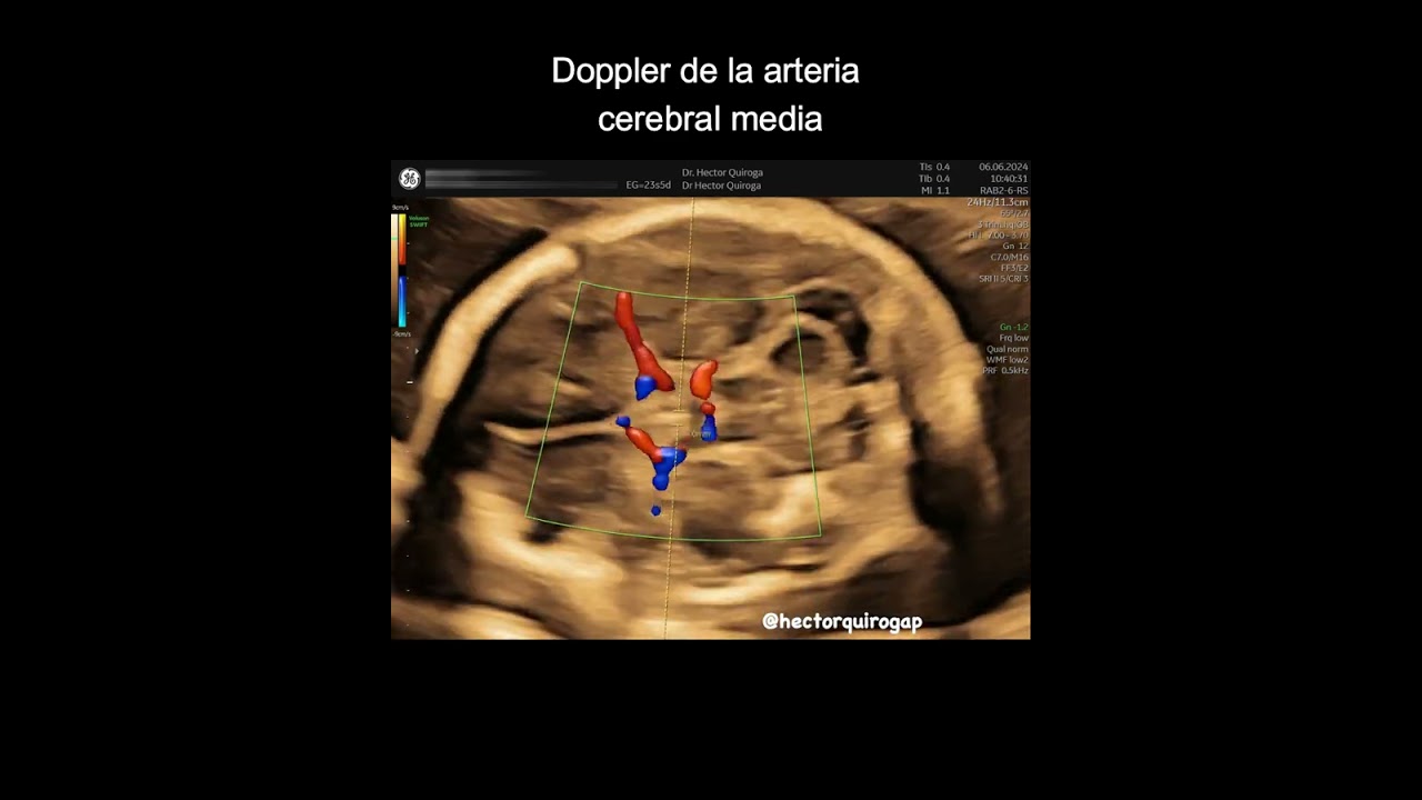 Doppler de la arteria cerebral media fetal.