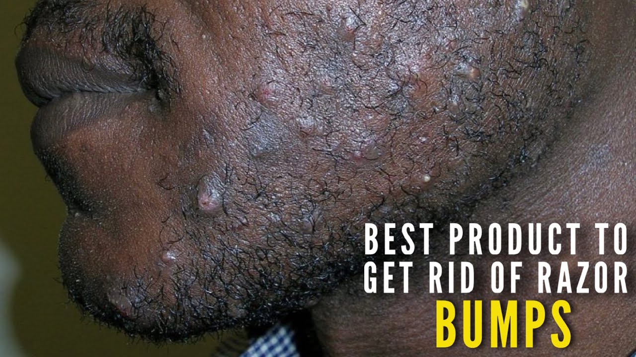 КАК БЫСТРО ИЗБАВИТЬСЯ ОТ ПОВРЕЖДЕНИЙ ОТ БРИТВЫ! | Парикмахер Лютер Кинг | #поврежденияотбритвы #п...