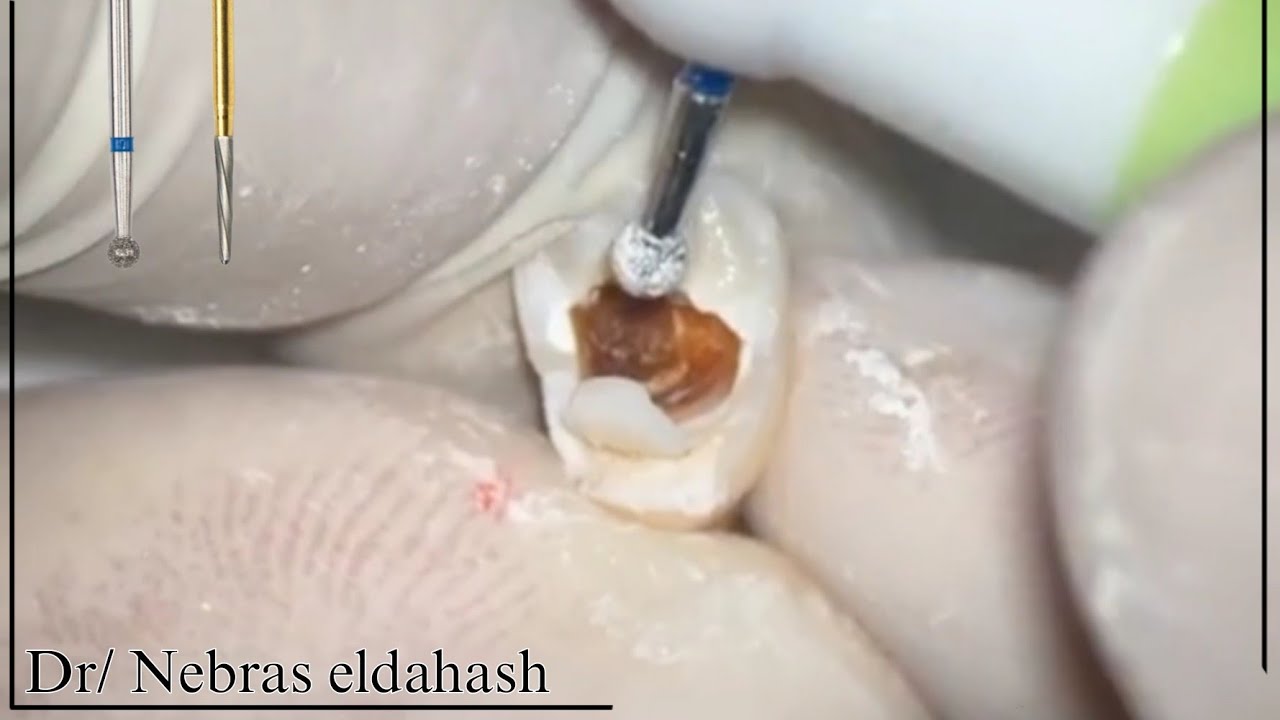 access cavity preparation for badly decayed maxillary Premolar (upper 4)