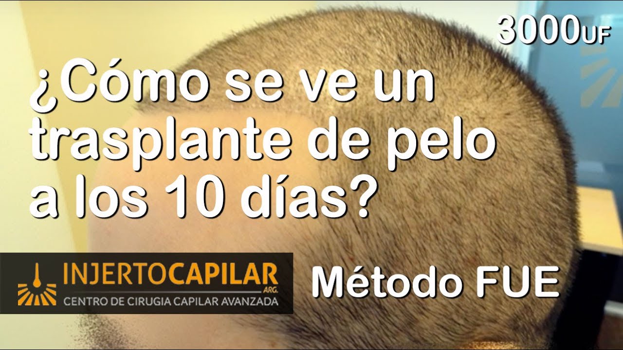 Recuperación de la zona  donante a los 10 dias de una cirugia x Método FUE