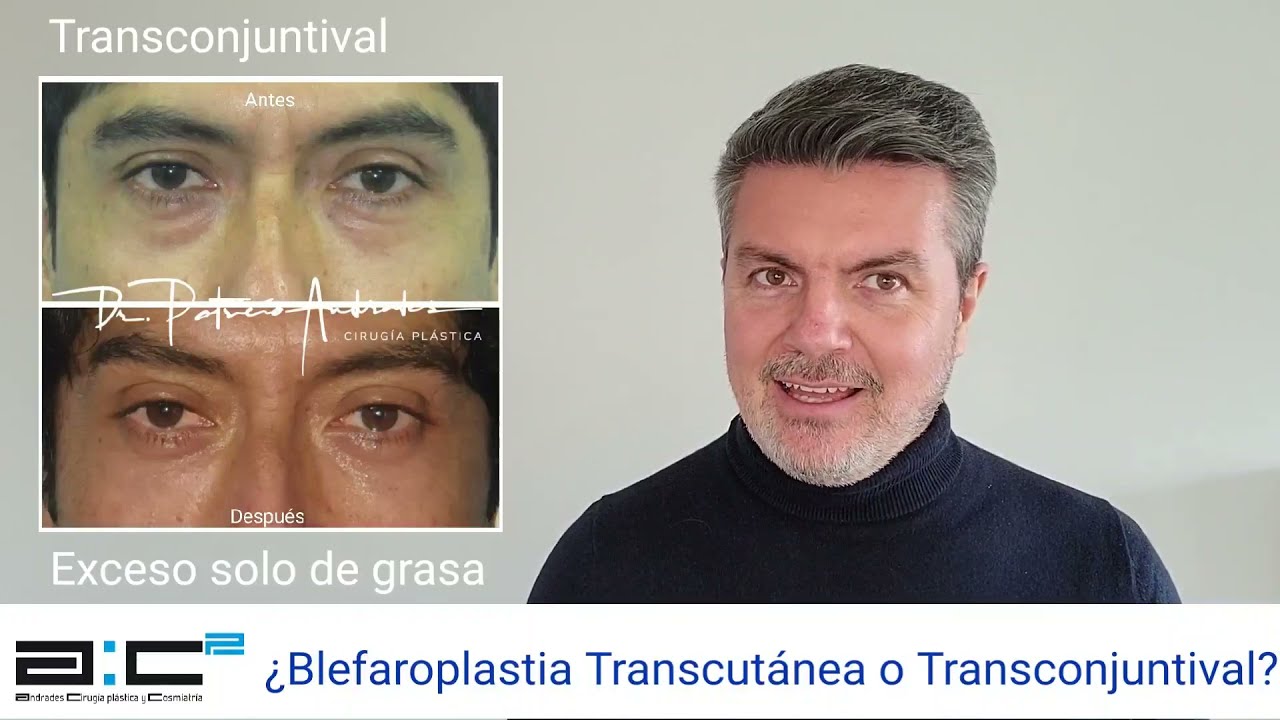 ¿Blefaroplastia Inferior Transcutánea o Transconjuntival?