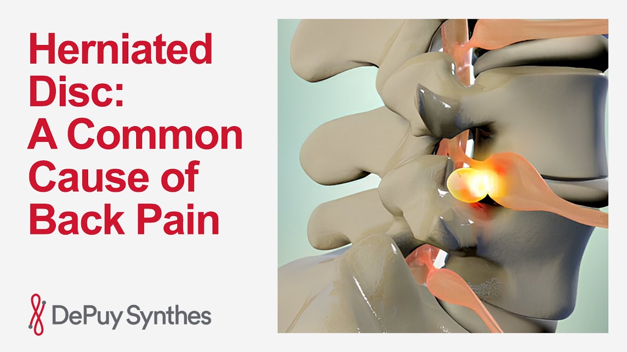 What Is a Herniated Disc? Causes and Symptoms Explained | DePuy Synthes