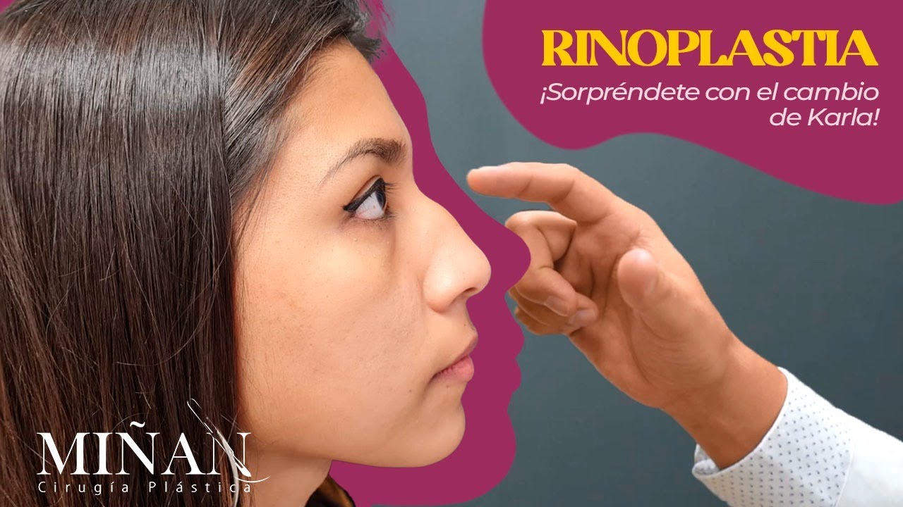 ¡Qué tal cambio en su nariz! 😱 RINOSEPTOPLASTIA de Karla | ESPECIALISTA EN RINOPLASTIA