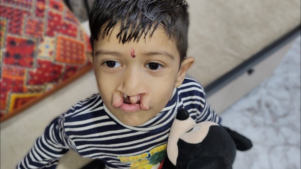 3 Year-Old with Untreated Cleft Lip and Palate | Dr Parit Ladani
