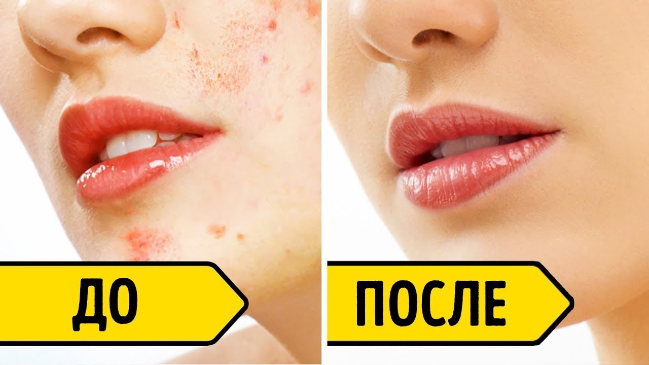 Как Избавиться от Следов После Акне за 3 Дня