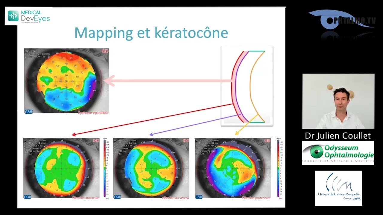Dr Julien COULLET: Mapping épithélial, quel intérêt en chirurgie réfractive ? Medical DevEyes