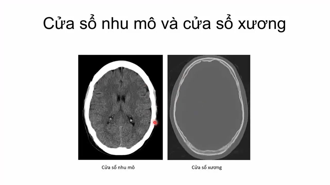 12. Hình ảnh học sọ não bình thường - ThS.BS. Nguyễn Thị Tố Quyên