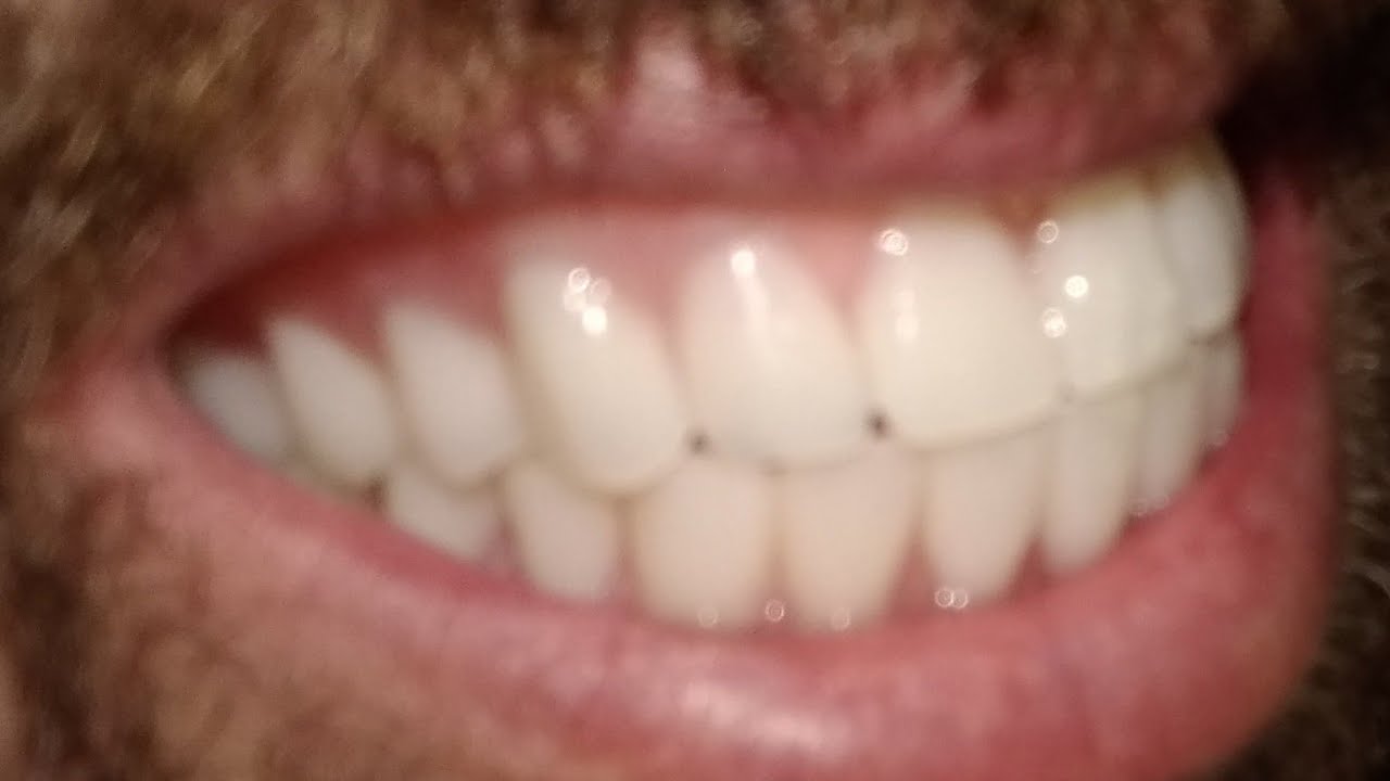 Relin-It Denture Reliner 6 Months update.