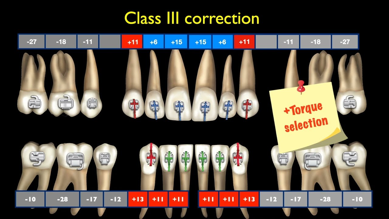 Solving anterior X-bite with Damon｜【Chris Chang Ortho】CC640