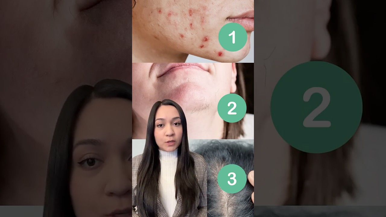 3 Ways PCOS Can Show Up on Your Skin | Polycystic Ovary Syndrome