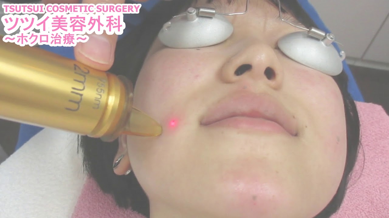 仕上がりがきれい！！Qスイッチレーザーを用いたホクロ除去治療。【ツツイ美容外科 (大阪心斎橋)】