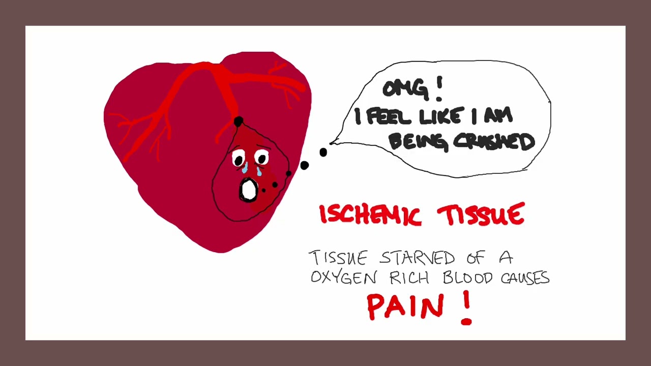 Myocardial Infarction
