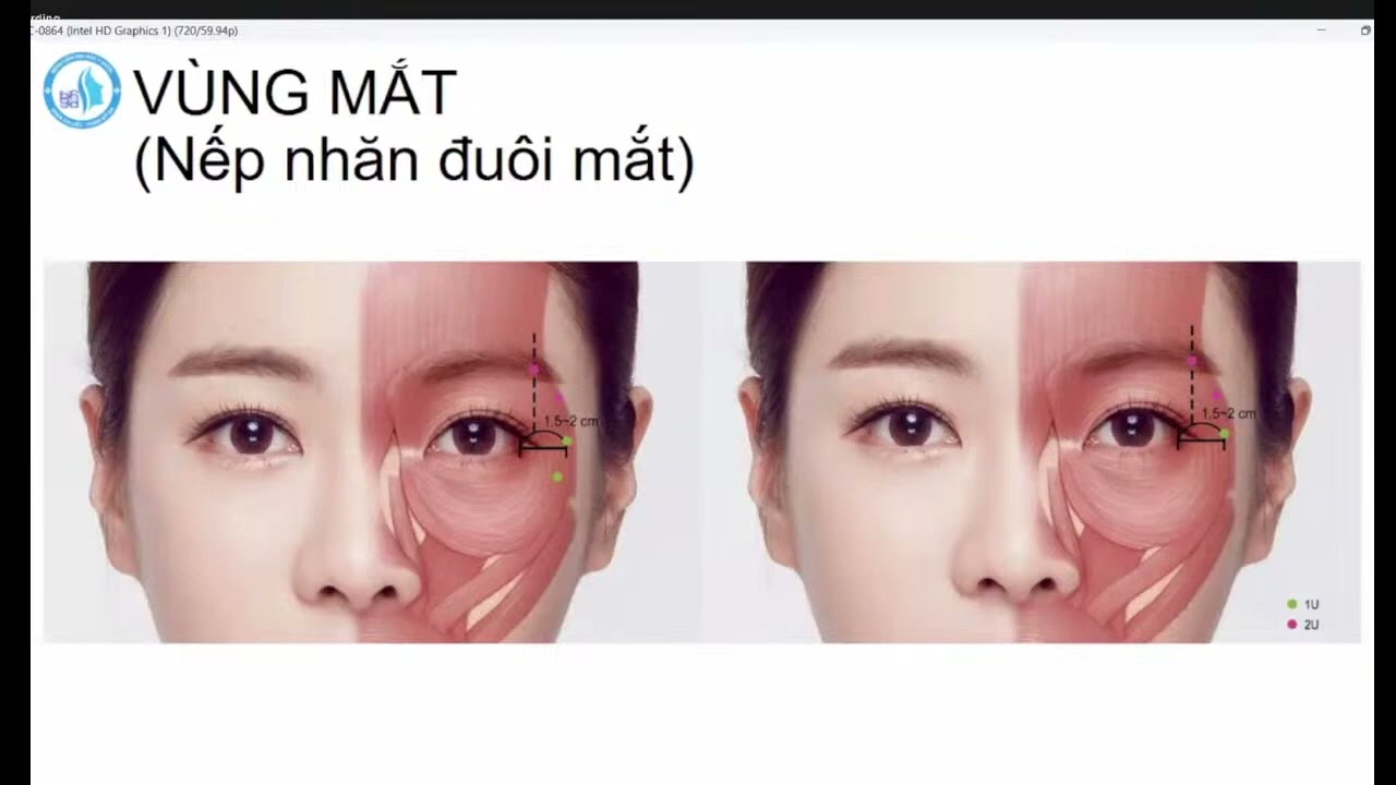 CẬP NHẬT BOTULINUM TOXIN TRONG DA LIỄU THẨM MỸ | ThS. BS. Tạ Quốc Hưng