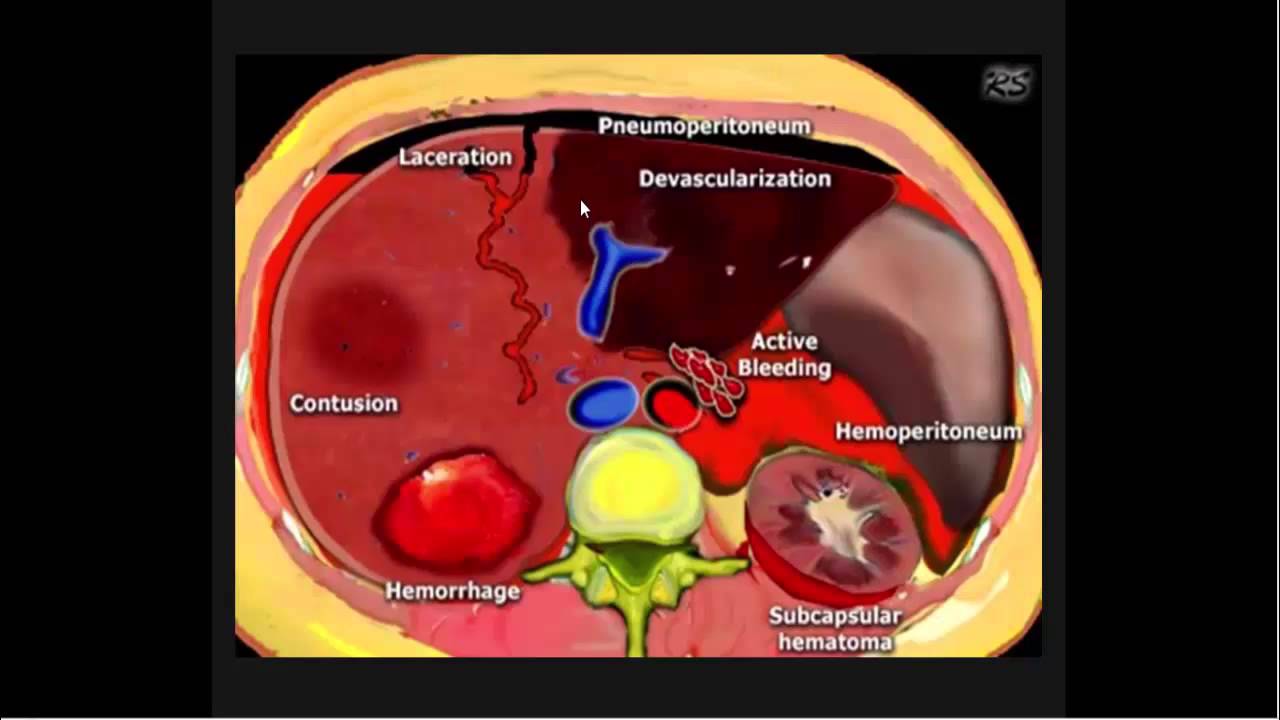 1-MAGING ABDOMINAL TRAUMA  INTRODUCTION PART 1 Dr AHMED ESAWY